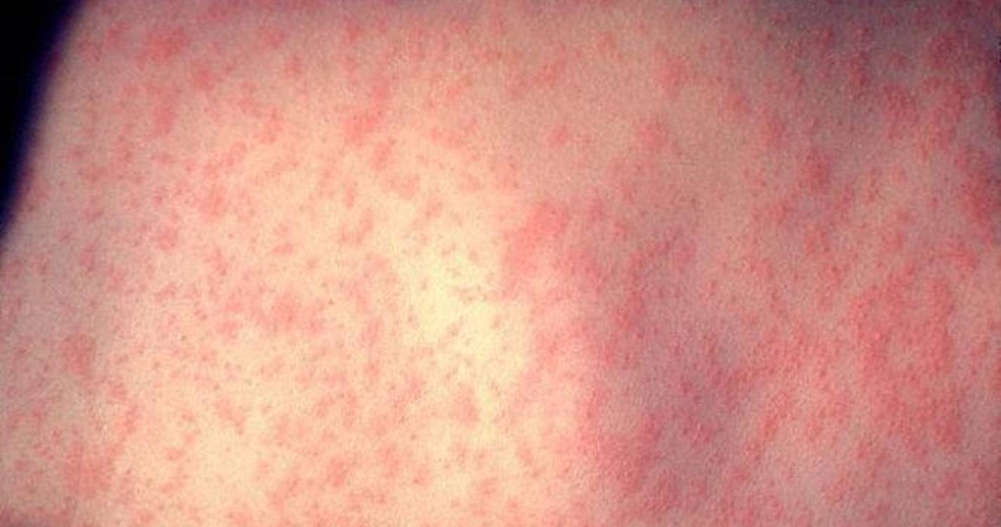 Sobe para 12 número de casos de sarampo em Portugal desde 11 de janeiro