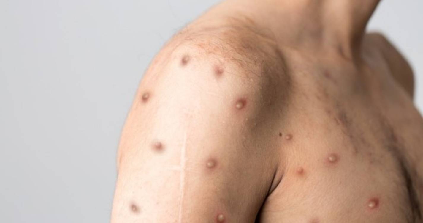 OMS declara monkeypox emergência de saúde global
