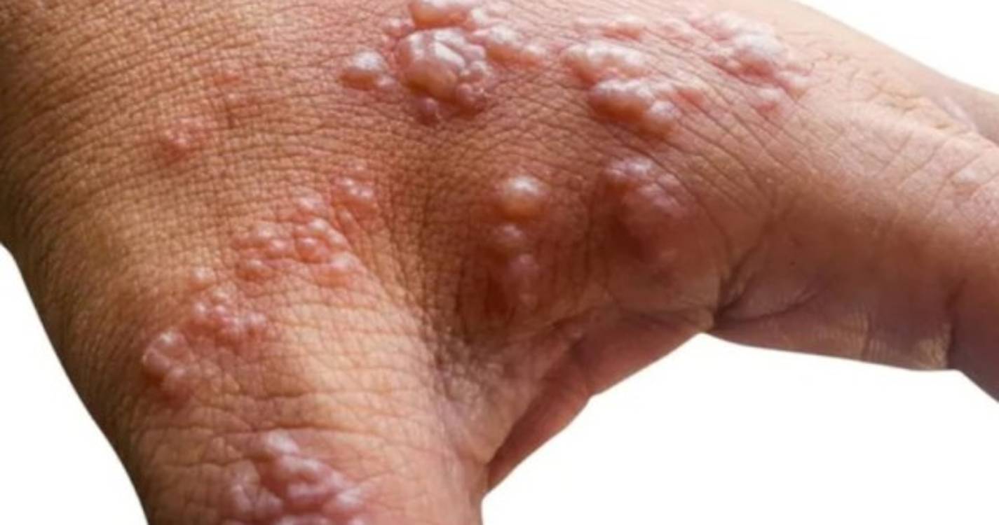 ONU alerta para linguagem estigmatizante de informações sobre surto de "Monkeypox"