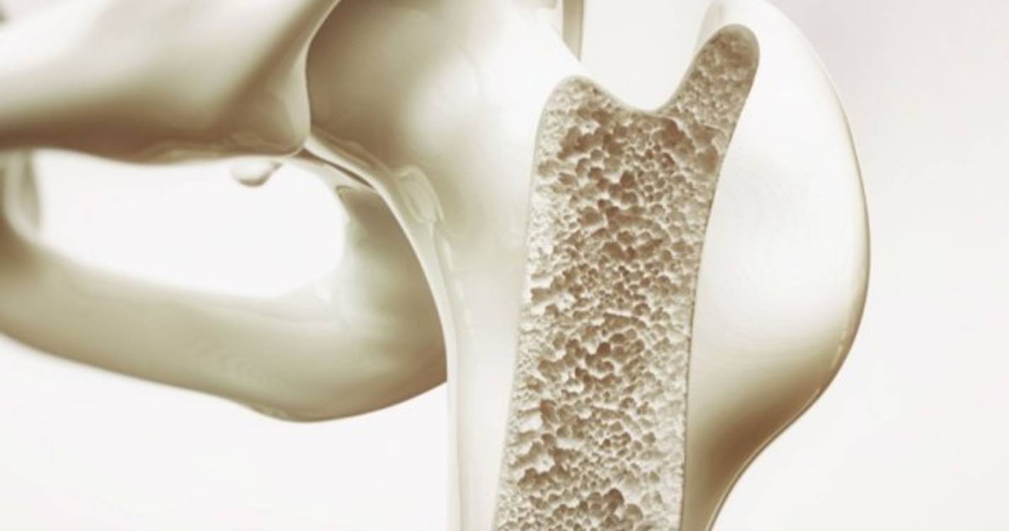 Confinamentos pioraram casos de osteoporose