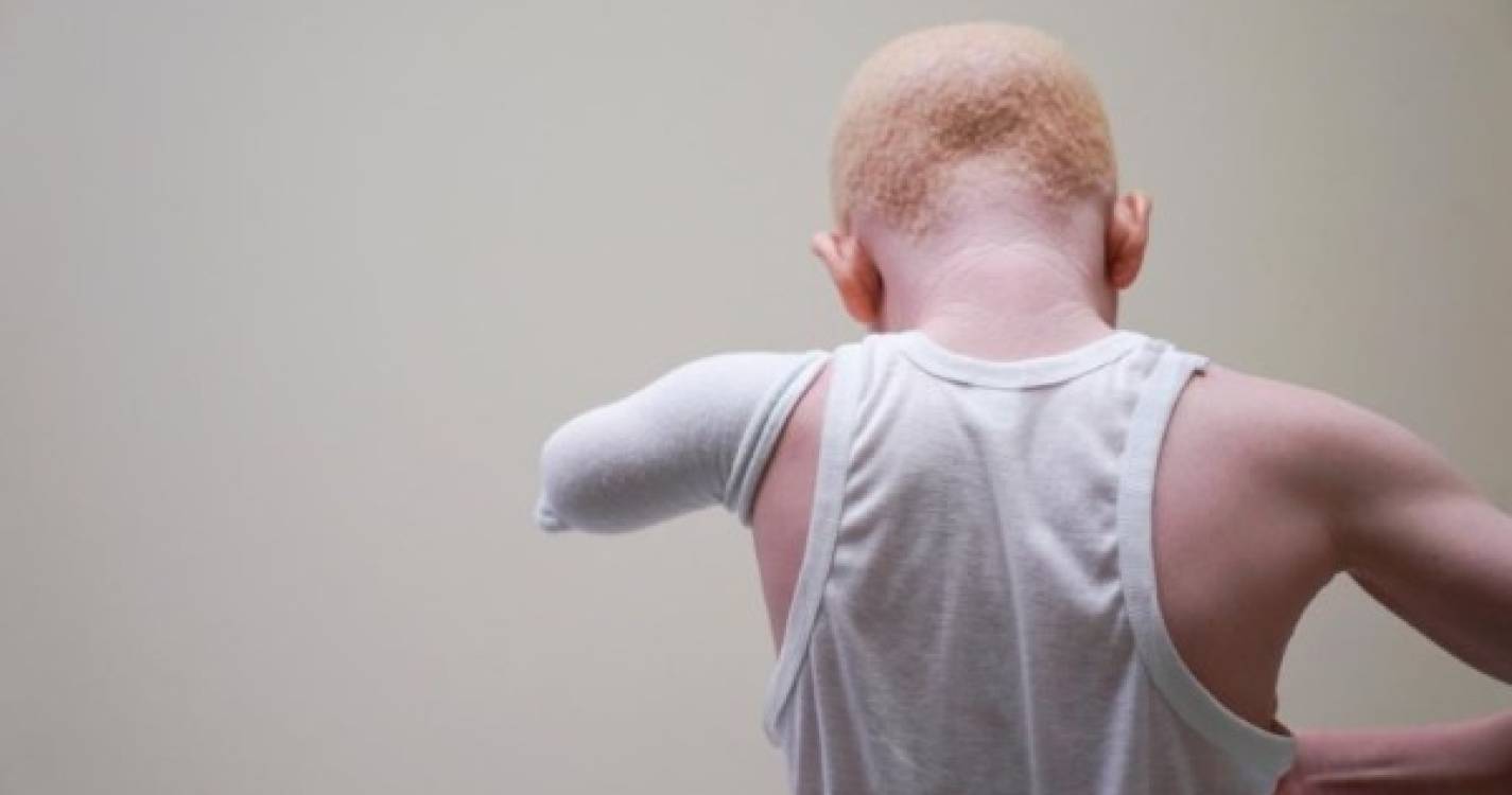 Amnistia denuncia assassínio ritual de menina albina de 3 anos no Malaui