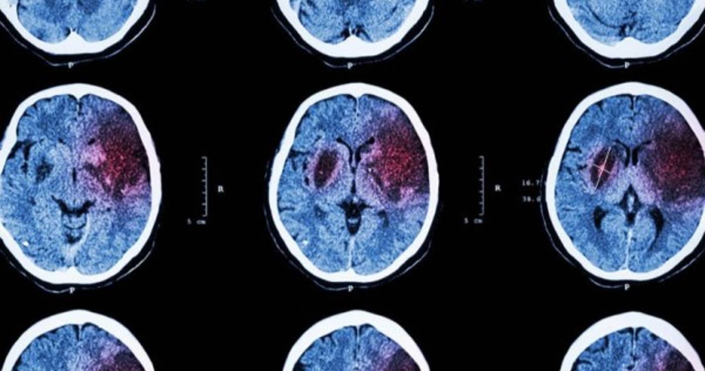 Inteligência artificial permite reduzir sequelas de AVC no Reino Unido