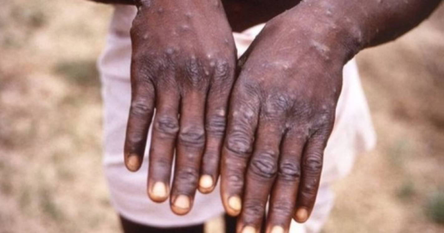Monkeypox: África CDC em negociações "muito avançadas" para obter vacinas