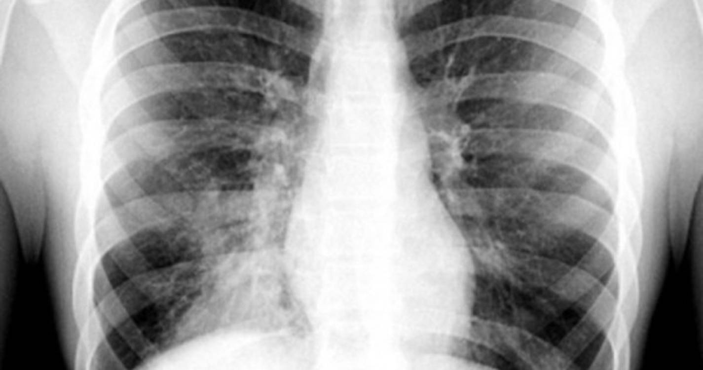 Casos de pneumonia infantil aumentam em Cabul com o iminente inverno