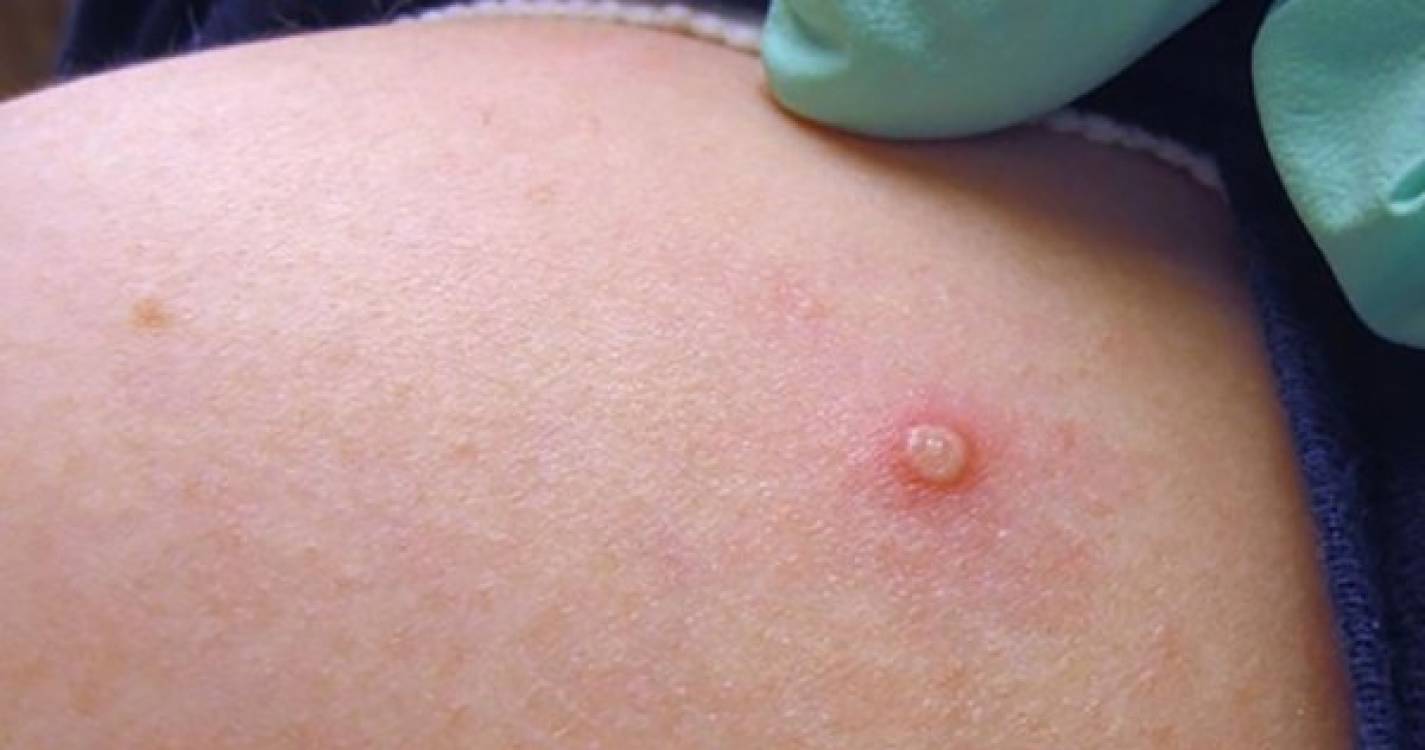 Monkeypox: Número de infeções em Portugal sobe para 770