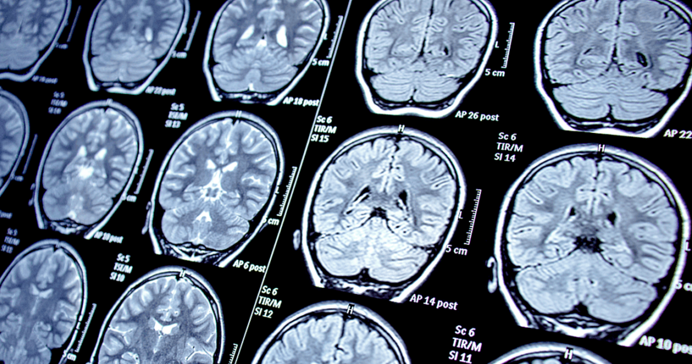 Cerca de metade da população mundial em 2021 tinha uma doença neurológica, calcula estudo