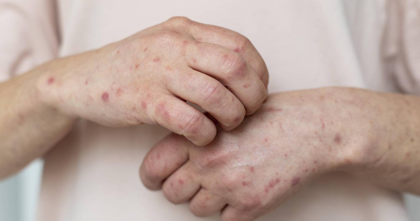 Morre nos EUA segunda criança que não estava vacinada contra o sarampo