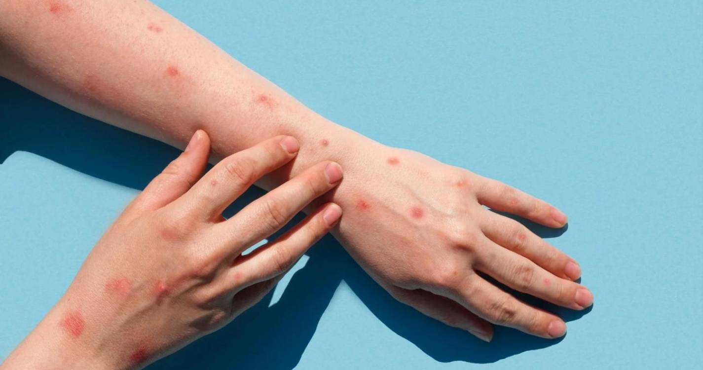 Mpox: Fabricante dinamarquês da vacina quer aprovação para adolescentes