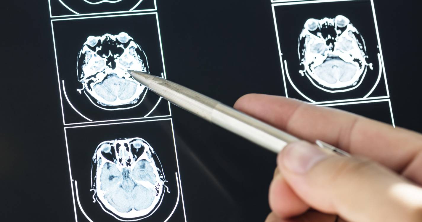 Recetores de sabor amargo podem aumentar eficácia do tratamento de tumor cerebral agressivo
