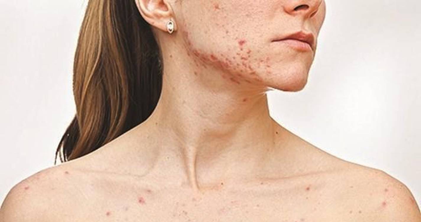 Número de casos de sarampo sobe para 14 em Portugal