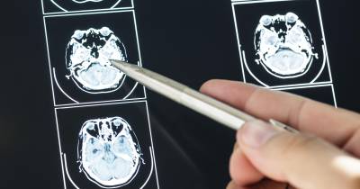 Recetores de sabor amargo podem aumentar eficácia do tratamento de tumor cerebral agressivo